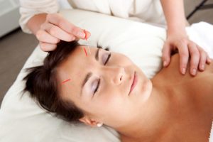 Acupuntura Lifting facial