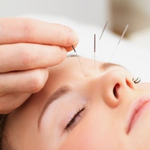 Acupuntura estética